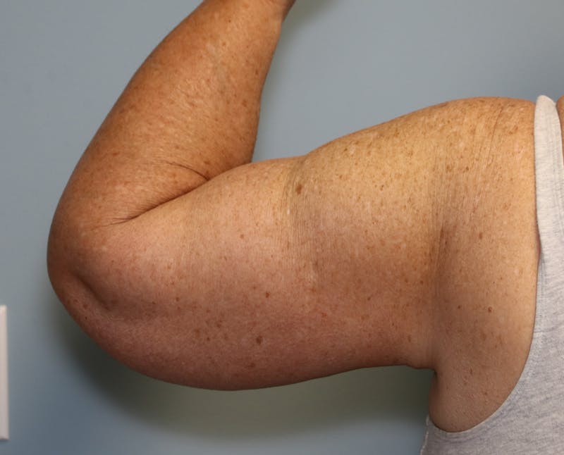 Brachioplasty (Arm Lift) Before & After Gallery - Patient 291055 - Image 6