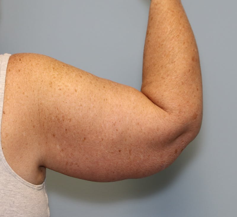 Brachioplasty (Arm Lift) Before & After Gallery - Patient 291055 - Image 7