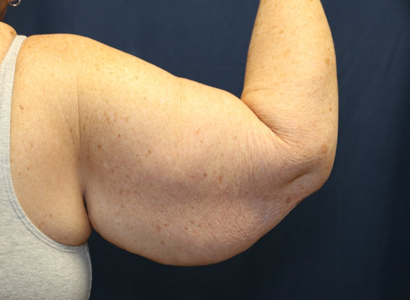 Brachioplasty (Arm Lift) Before & After Gallery - Patient 291055 - Image 8
