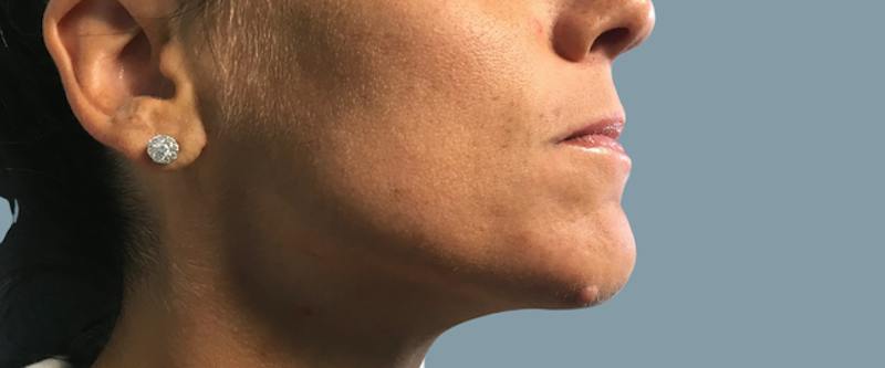 Cosmetic Lesion Removal Before & After Gallery - Patient 694220 - Image 1