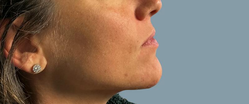 Cosmetic Lesion Removal Before & After Gallery - Patient 694220 - Image 2