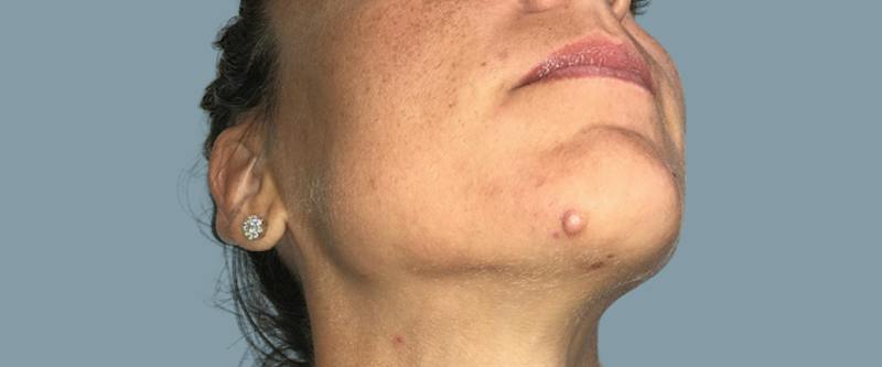 Cosmetic Lesion Removal Before & After Gallery - Patient 694220 - Image 3