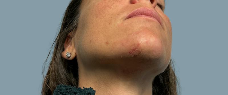 Cosmetic Lesion Removal Before & After Gallery - Patient 694220 - Image 4