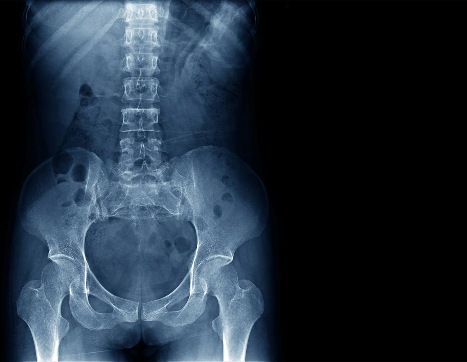 X-ray of the lower spine