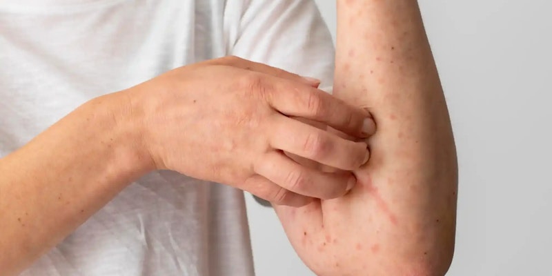 Urticária: o que é, sintomas, causas e tratamento