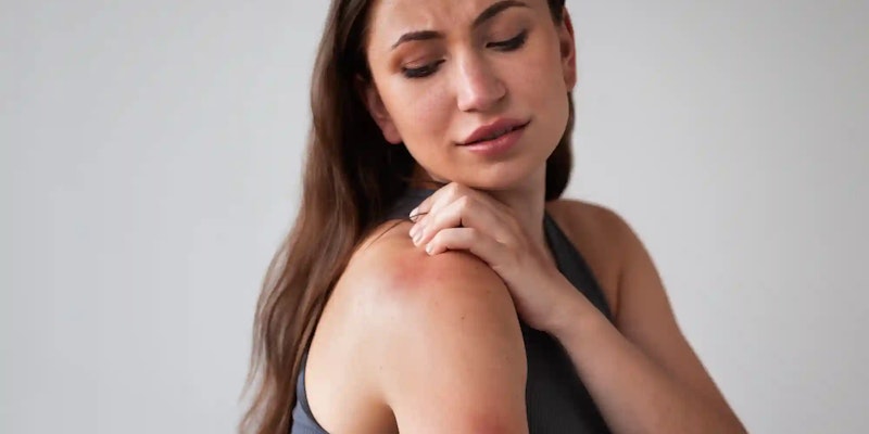 Mulher com mancha no ombro indicando lúpus