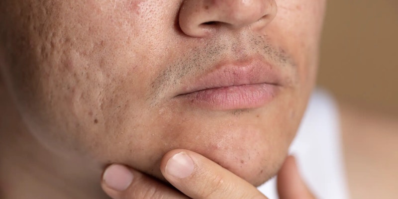 Berne: Cuidados, sintomas e tratamento