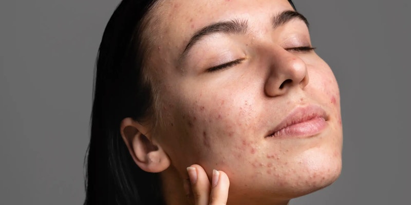 Melasma: o que é, causas e tratamentos