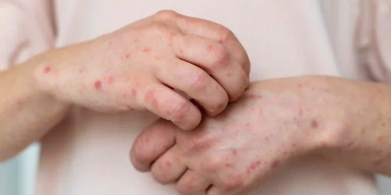 Sífilis tem cura? Sintomas, tratamentos e mais!