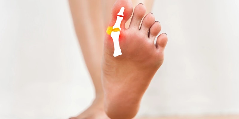 Joanete: O que é, causas e tratamentos