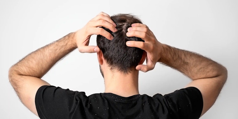 Caspa: Causas, Tratamentos e Prevenção