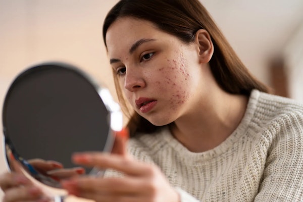 Rubor Facial: o que é, causas e tratamento