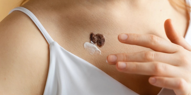 Doença de Lyme: o que é, sintomas e tratamentos possíveis