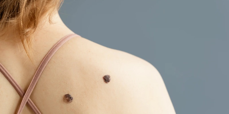 Doença de chagas: sintomas, causas e como tratar