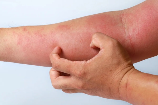 Coceira no corpo: causas e como tratar