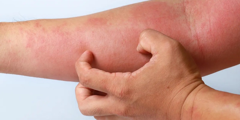 Coceira no corpo: causas e como tratar