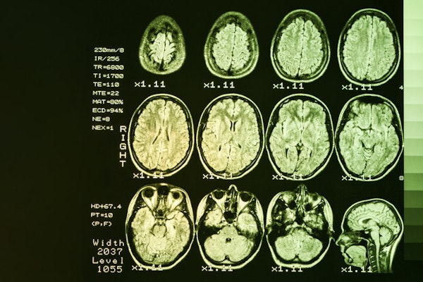 Doença de Huntington: como reconhecer os sintomas e buscar tratamentos eficazes