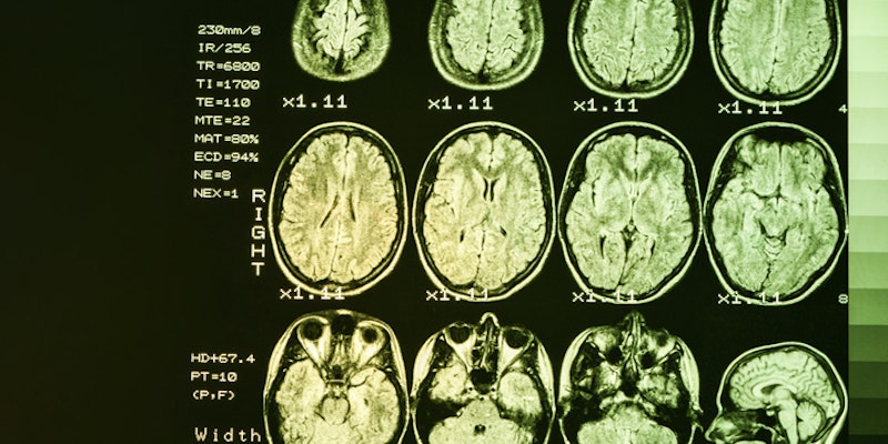 Doença de Huntington: como reconhecer os sintomas e buscar tratamentos eficazes