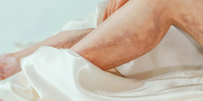 O que é microangiopatia e quais os sintomas?