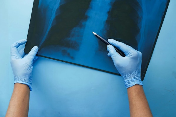 Quais os sintomas da Embolia Pulmonar?