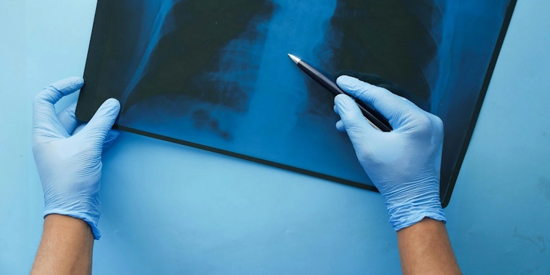 Quais os sintomas da Embolia Pulmonar?