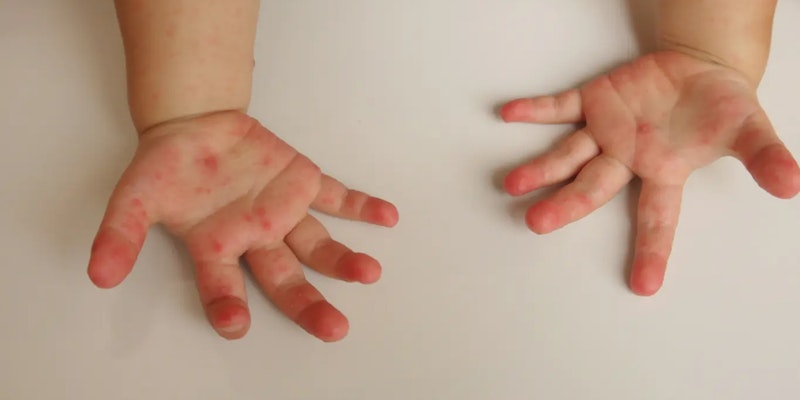 Doença mão-pé-boca: o que é, como identificar e cuidar com segurança