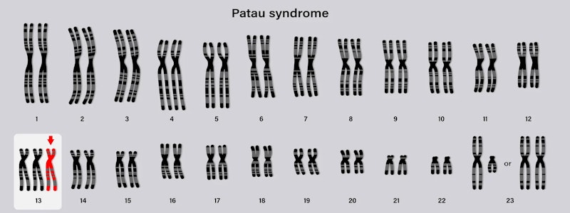 Síndrome de Patau: sintomas, diagnóstico e cuidados essenciais