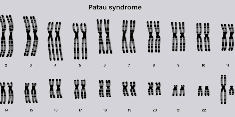 Síndrome de Patau: sintomas, diagnóstico e cuidados essenciais