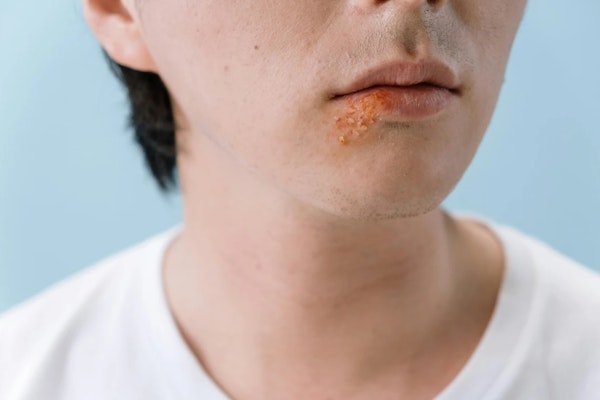Conheça os sintomas, sinais e causas do herpes labial para saber quando buscar ajuda