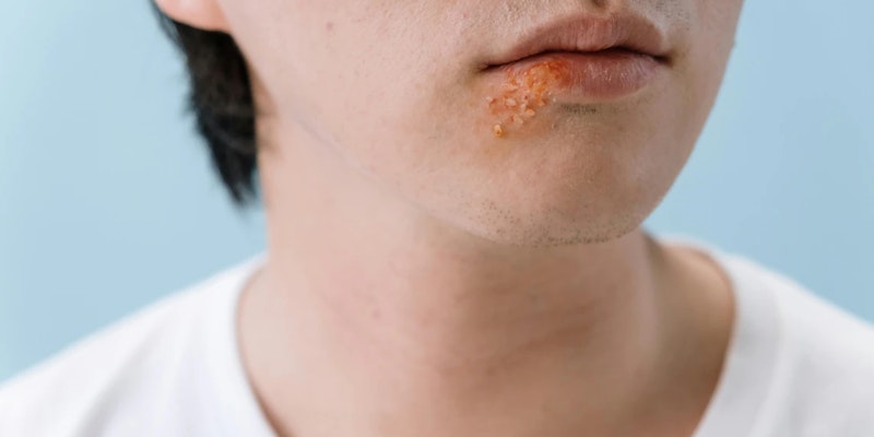 Conheça os sintomas, sinais e causas do herpes labial para saber quando buscar ajuda