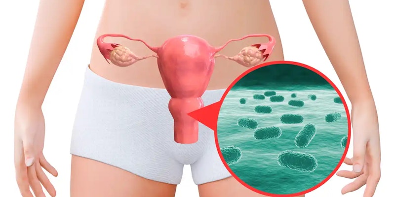 Entenda a vaginose bacteriana