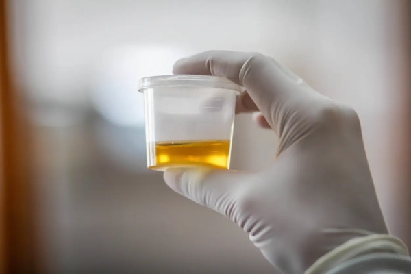 Sangue na urina: o que pode estar por trás desse sintoma?