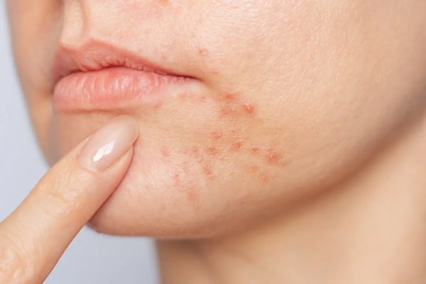 Conheça os benefícios do Roacutan e os cuidados necessários no tratamento da acne