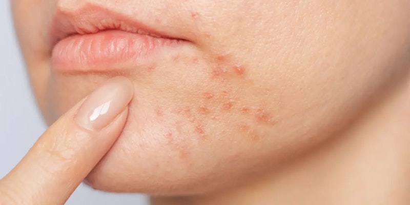 Conheça os benefícios do Roacutan e os cuidados necessários no tratamento da acne