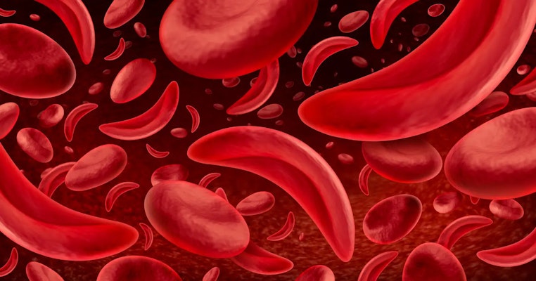 Conheça as causas da anemia falciforme, seus sintomas e cuidados essenciais
