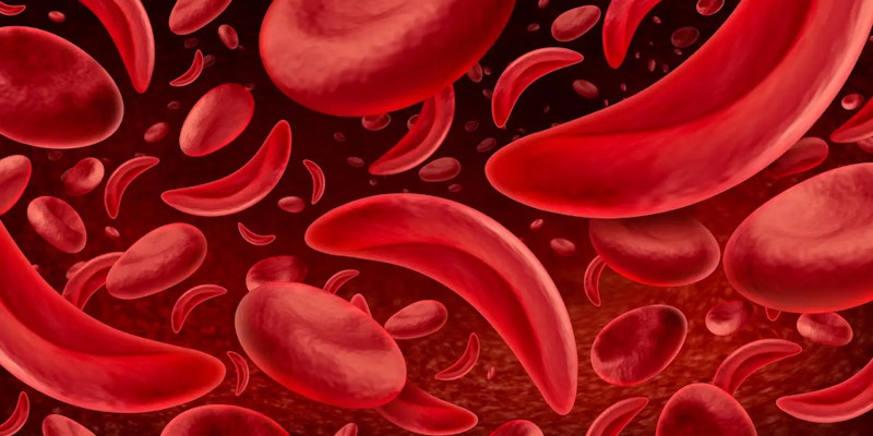Conheça as causas da anemia falciforme, seus sintomas e cuidados essenciais