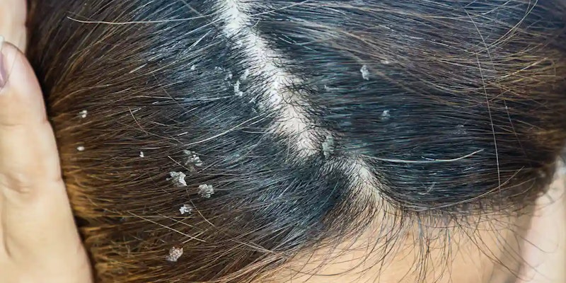 O que está por trás da dermatite seborreica, uma inflamação que causa caspa e irritação na pele
