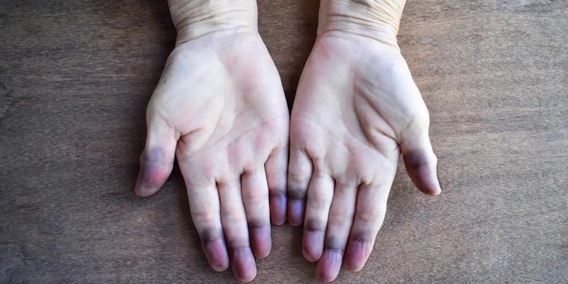 Cianose: o que é, causas e quando buscar ajuda