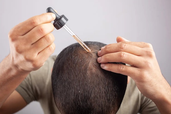 Minoxidil e saúde capilar: tudo sobre o tratamento que ajuda no crescimento dos fios