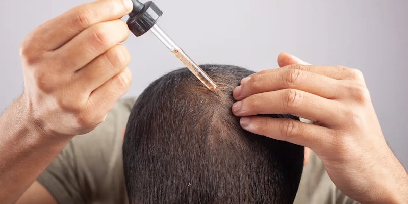 Minoxidil e saúde capilar: tudo sobre o tratamento que ajuda no crescimento dos fios