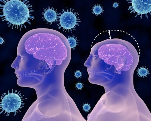 Microcefalia: terapias para esse tipo de condição