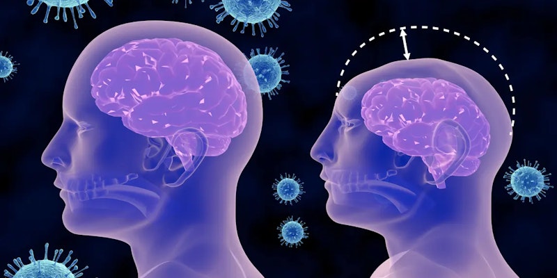 Microcefalia: terapias para esse tipo de condição