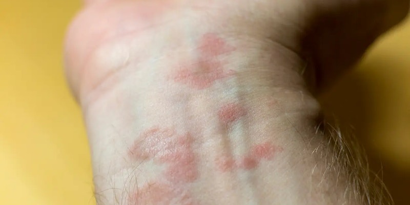 Sarna crostosa: entenda a forma mais grave da escabiose e como tratar