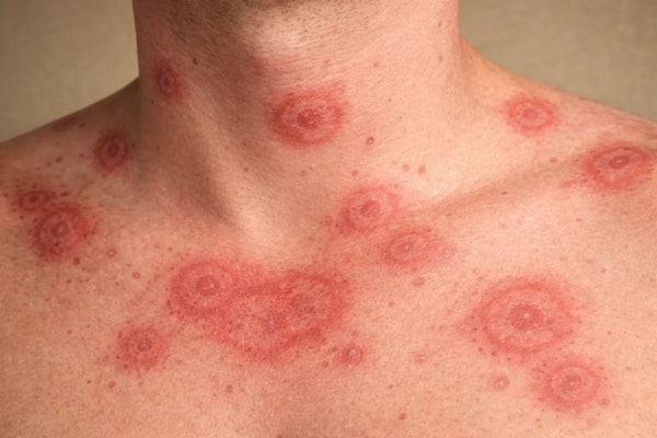 Eritema: quando a vermelhidão da pele merece atenção