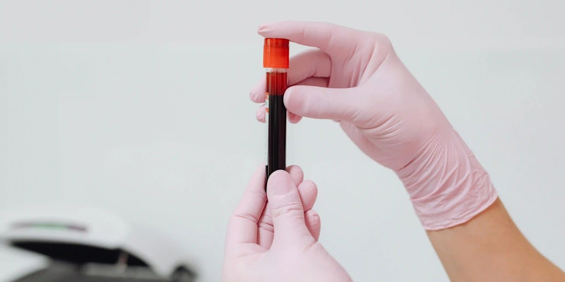 Imagem de uma coleta de exame de sangue para realizar a contagem de plaquetas.