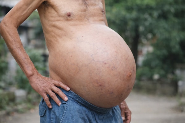 Imagem de pessoa com ascite.