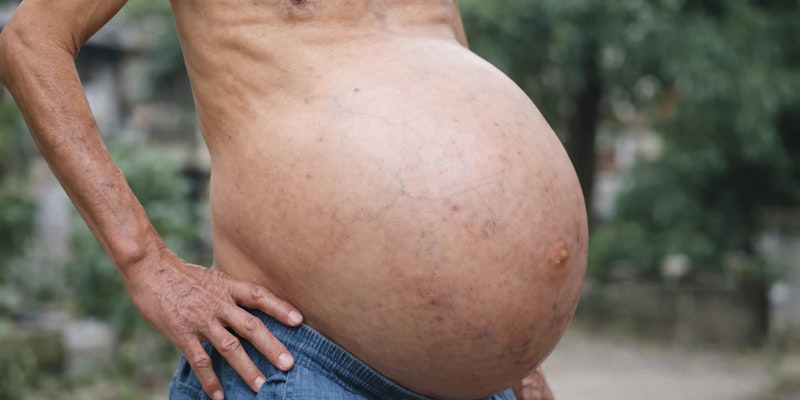 Imagem de pessoa com ascite.