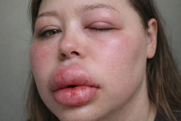 Imagem de uma pessoa com angiodema hereditário.