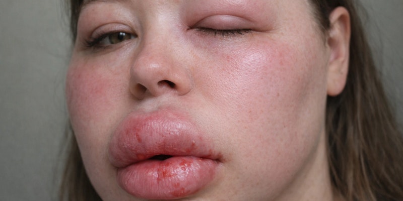 Imagem de uma pessoa com angiodema hereditário.
