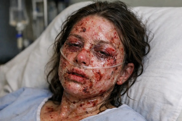 Imagem de mulher em leito com Síndrome de Stevens-Johnson.